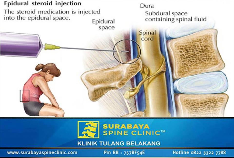 Injeksi Steroid Epidural